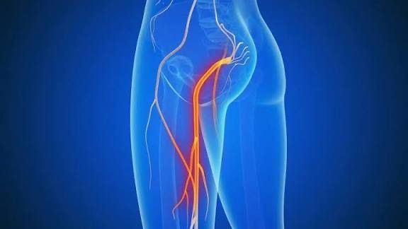 Siyatik Sinir Sıkışması - Beylikdüzü Fizyoterapi